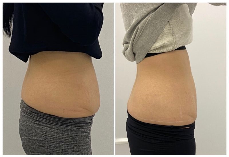 Fotona-Tight-Scultping-lipoliza-laserowa-efekty-w-Wellclinic.jpg