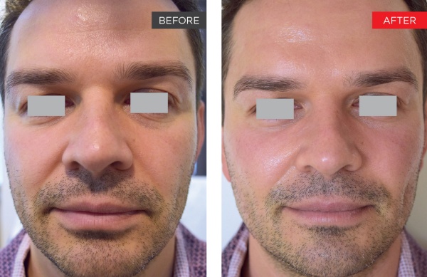 Fotona 4D Endolifting przed i po efekty