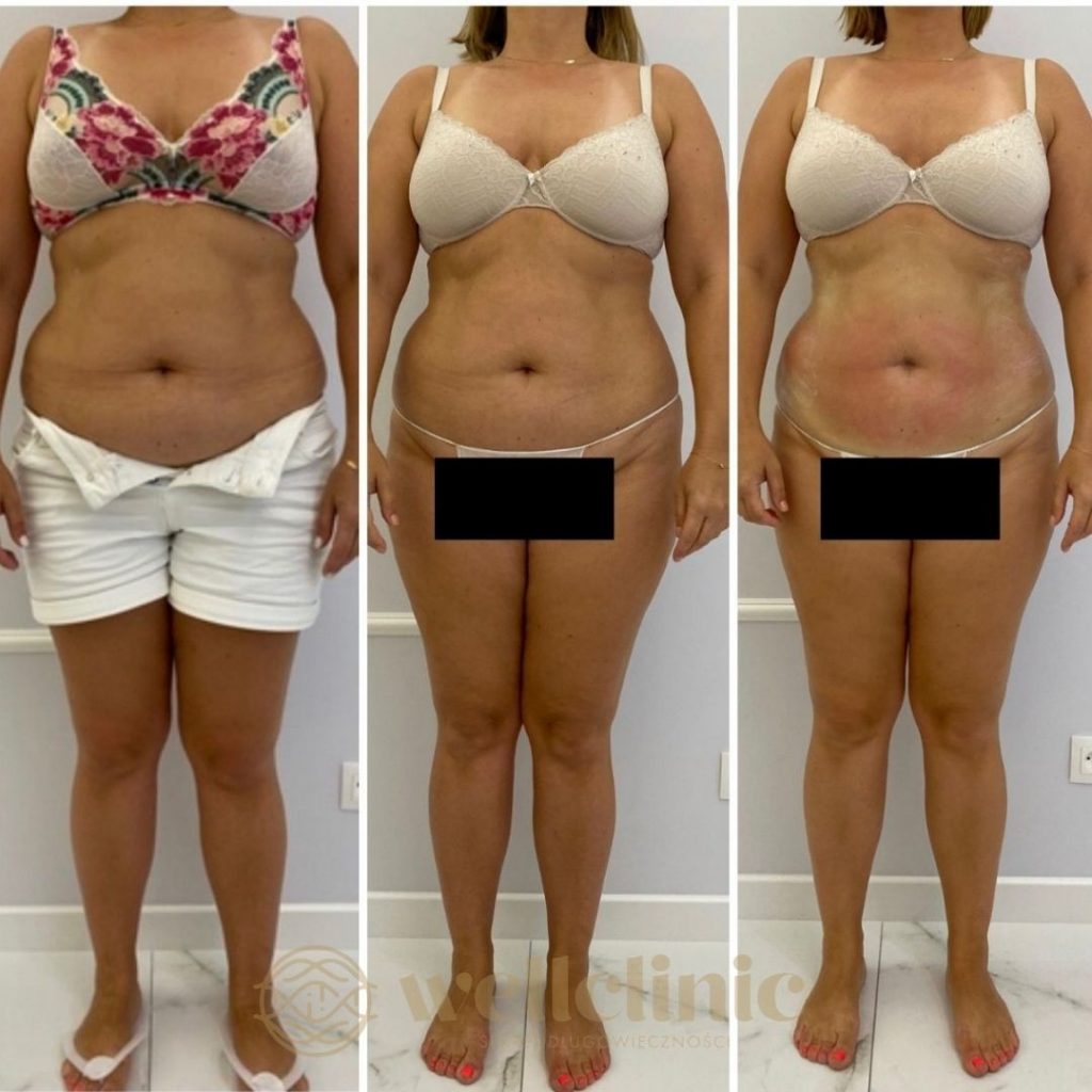 Efekty modelowania sylwetki liposukcja warszawa