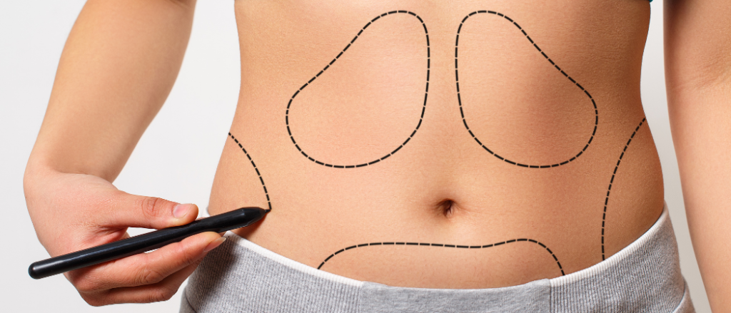 Laser-Liposuktionsbehandlung - Tight Sculpting