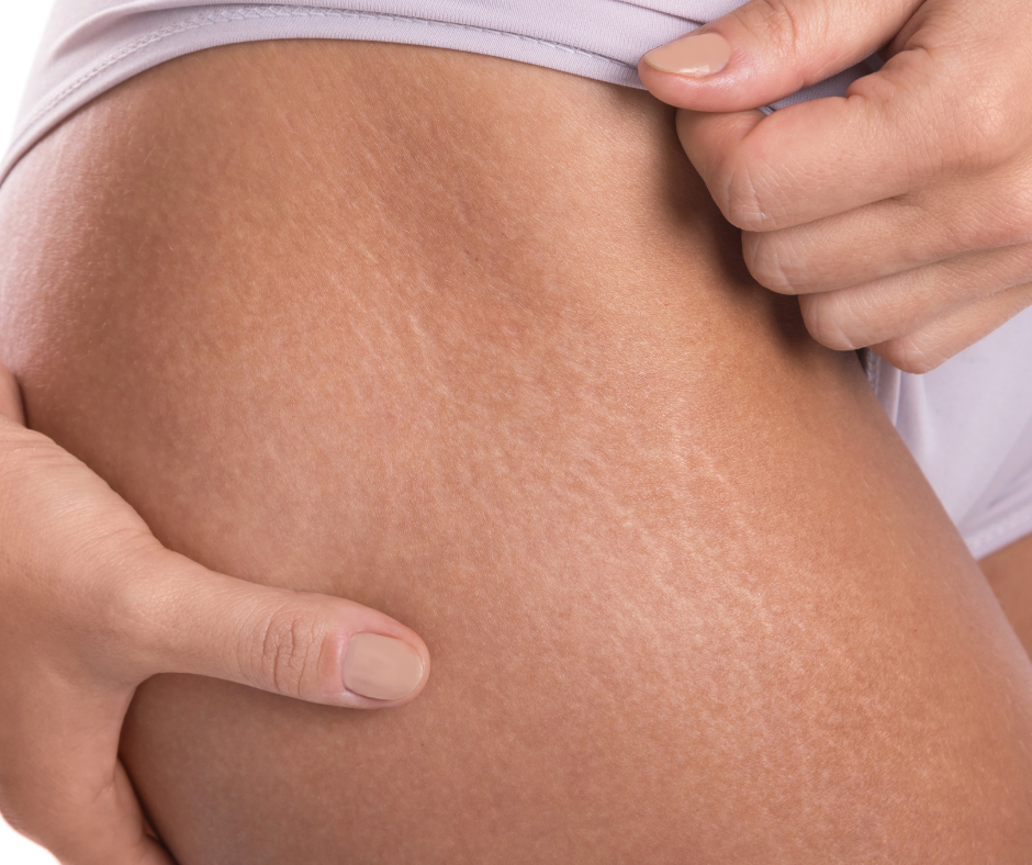 removal of stretch marks