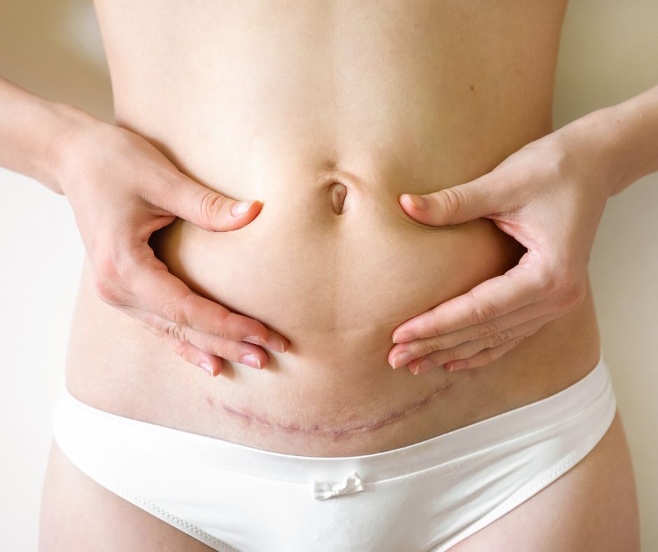 Endometriosis excision scar - how is it removed?