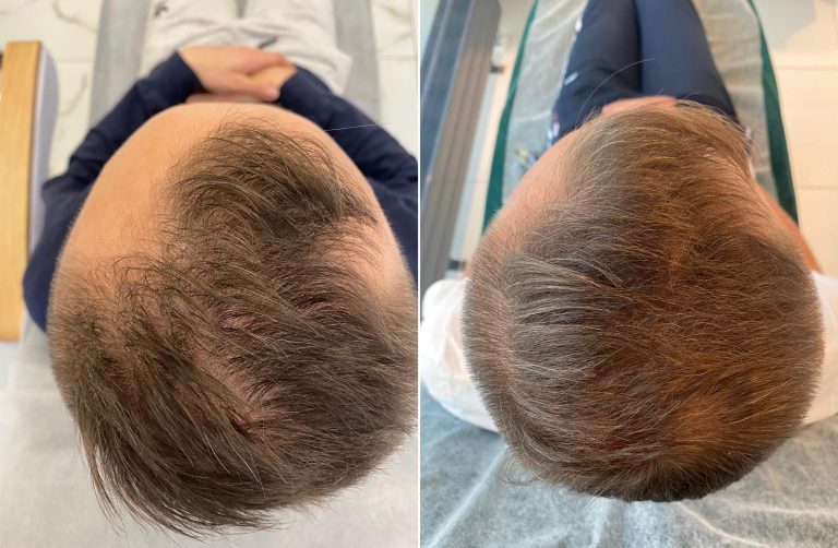 Leczenie łysienia w Wellclinic