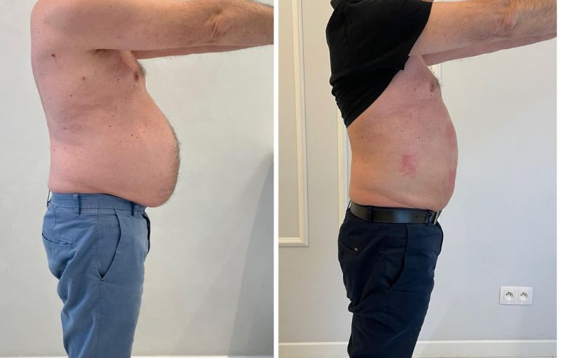 Przed i po, odchudzanie meżczyzna, liposukcja laserowa 3